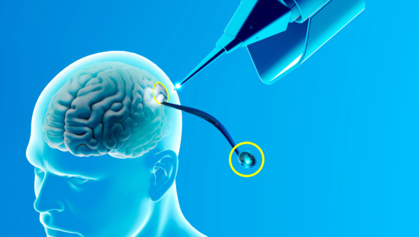 Neuralink: Erstes Gehirnimplantat erfolgreich eingesetzt!